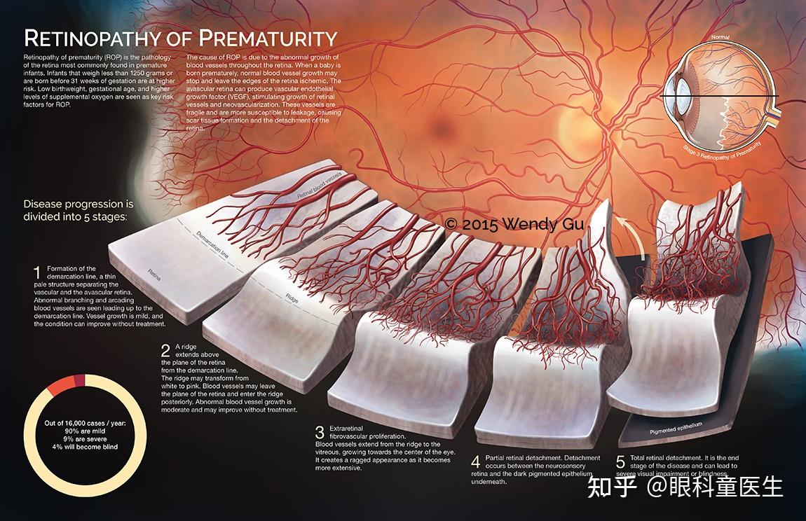 neuroretinopathy图片