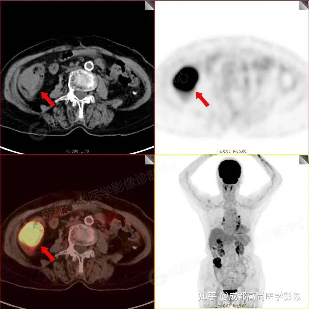 【高尚病例】PET/CT诊断结肠癌1例 - 知乎