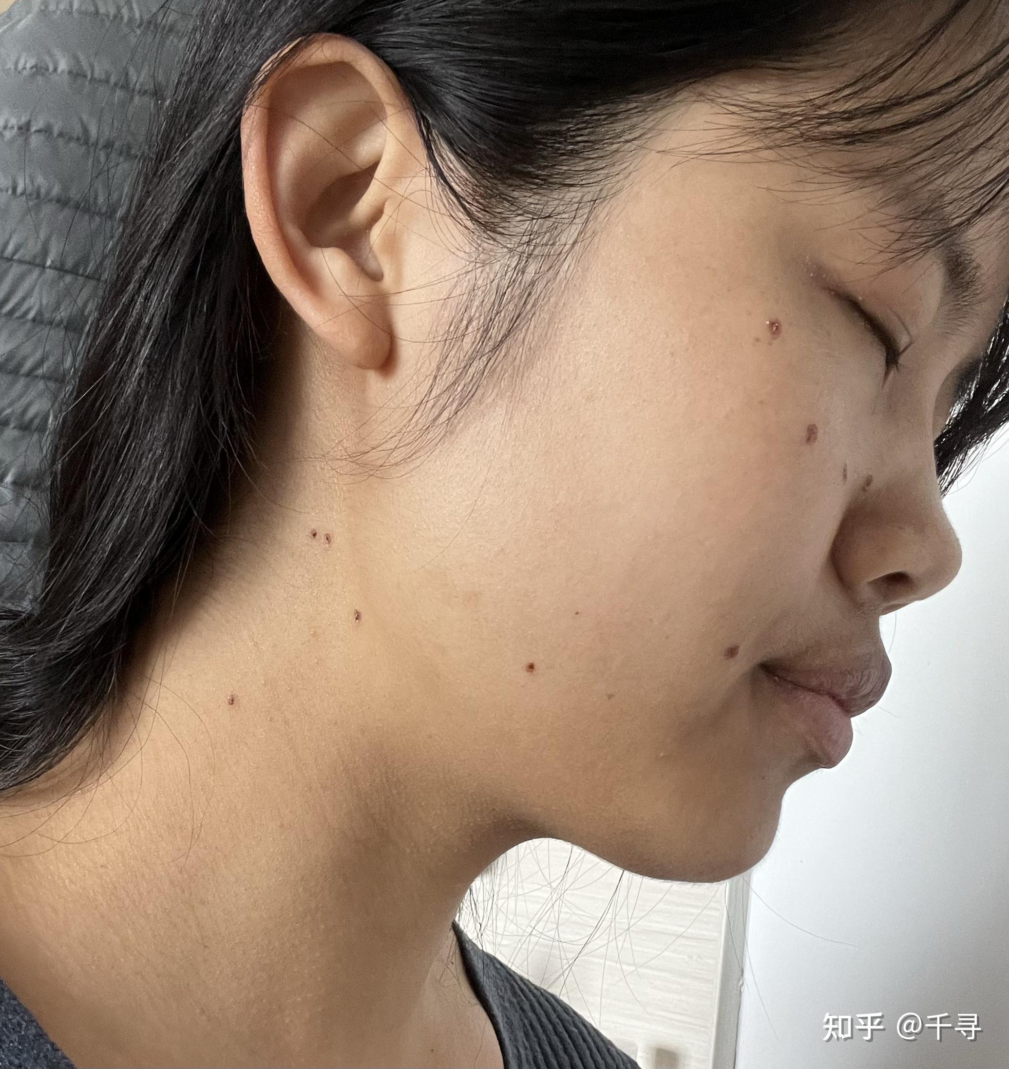 药水点痣vs激光点痣