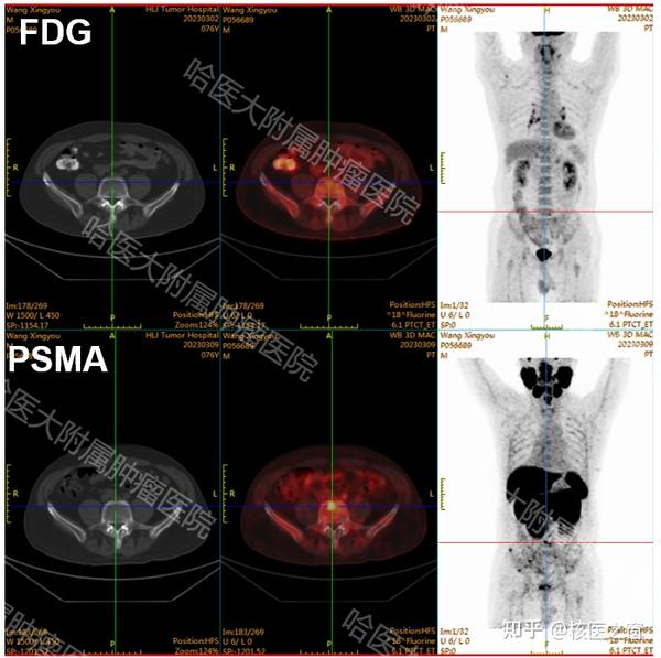【专家解说】王可铮：“精确制导”PET/CT—18F-PSMA-1007特异性分子探针助力前列腺癌精准诊疗！ - 知乎