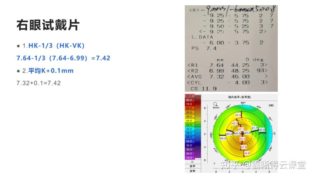 圆锥角膜的RGP验配及RGP临床效果分析（文字版） - 知乎