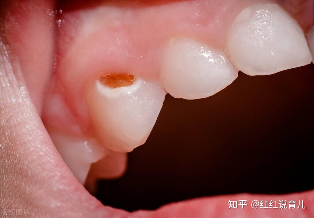 红红5岁半的儿子龋齿了,上门牙正中有个椭圆形的龋齿洞,吃什么塞什么