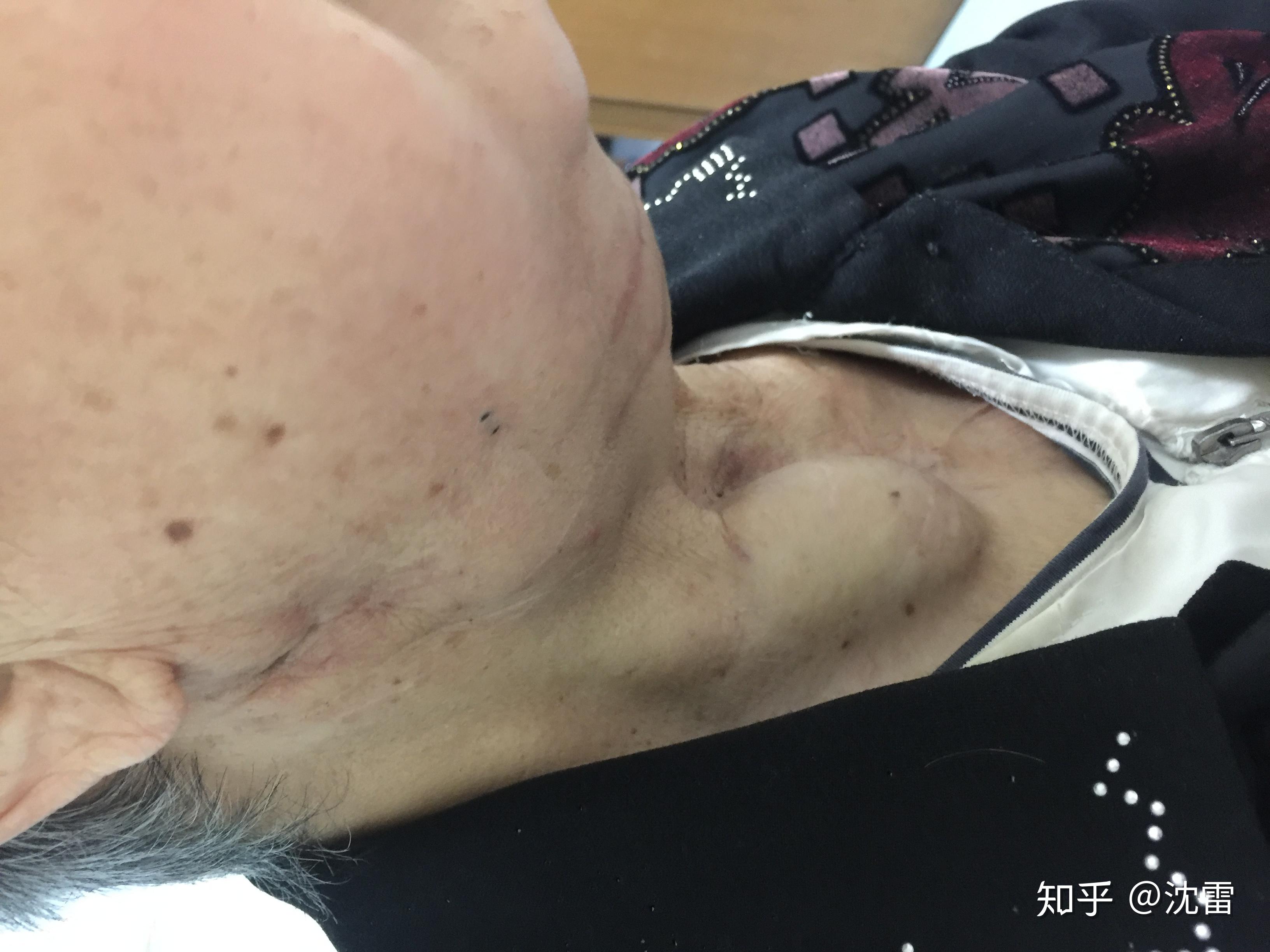 頻繁淋巴結轉移—甲狀腺癌術後難題