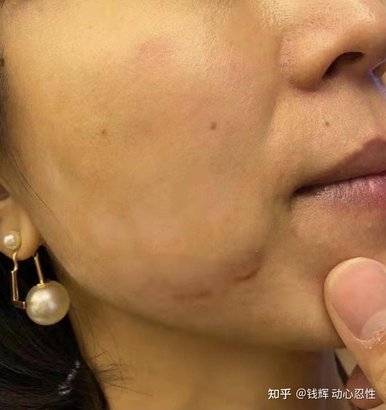 非正规热玛吉治疗后所出现的副作用