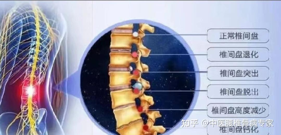 腰椎终板位置图片图片