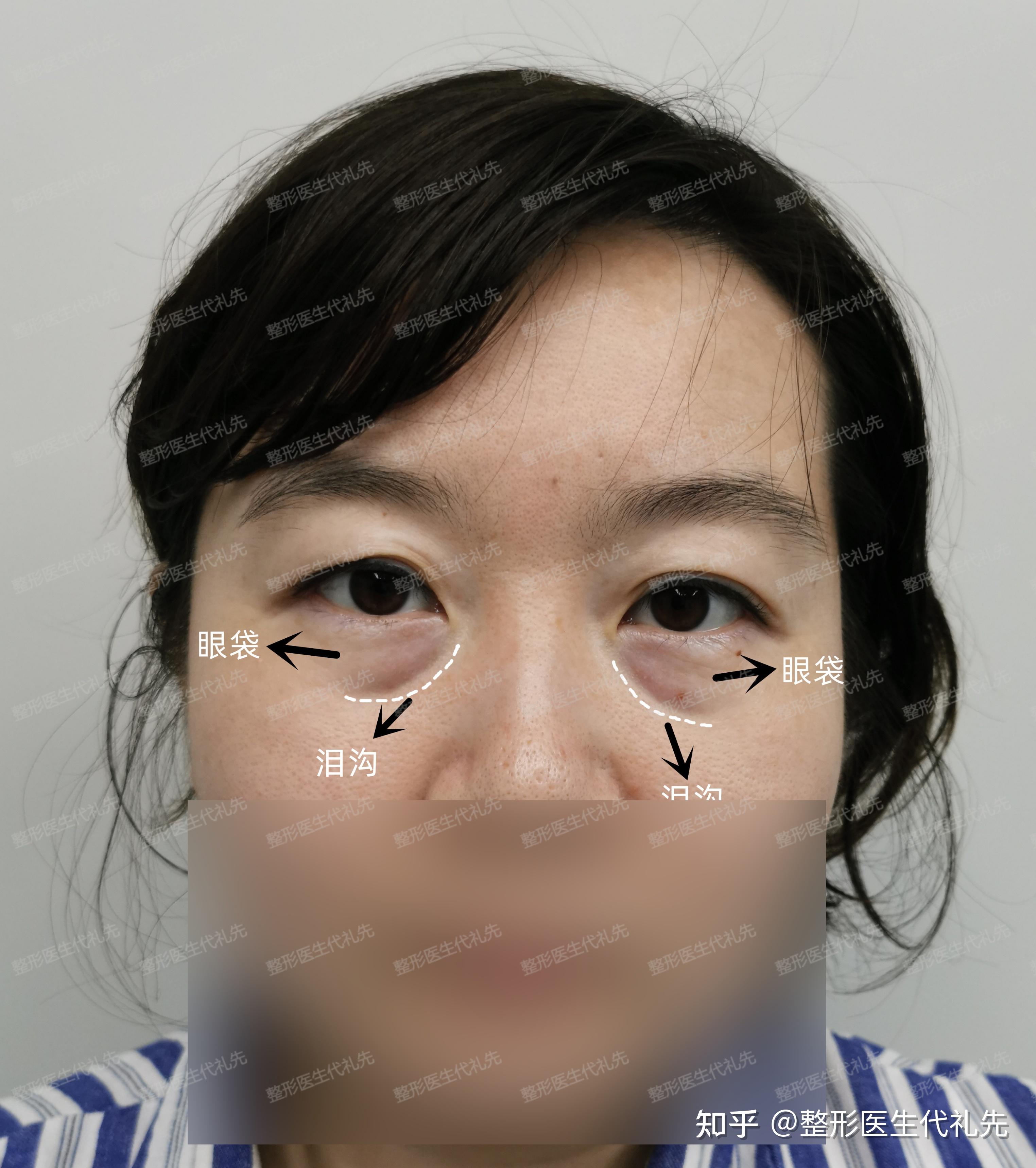 眼周年轻化|泪沟的形成有以下3种原因 - 知乎