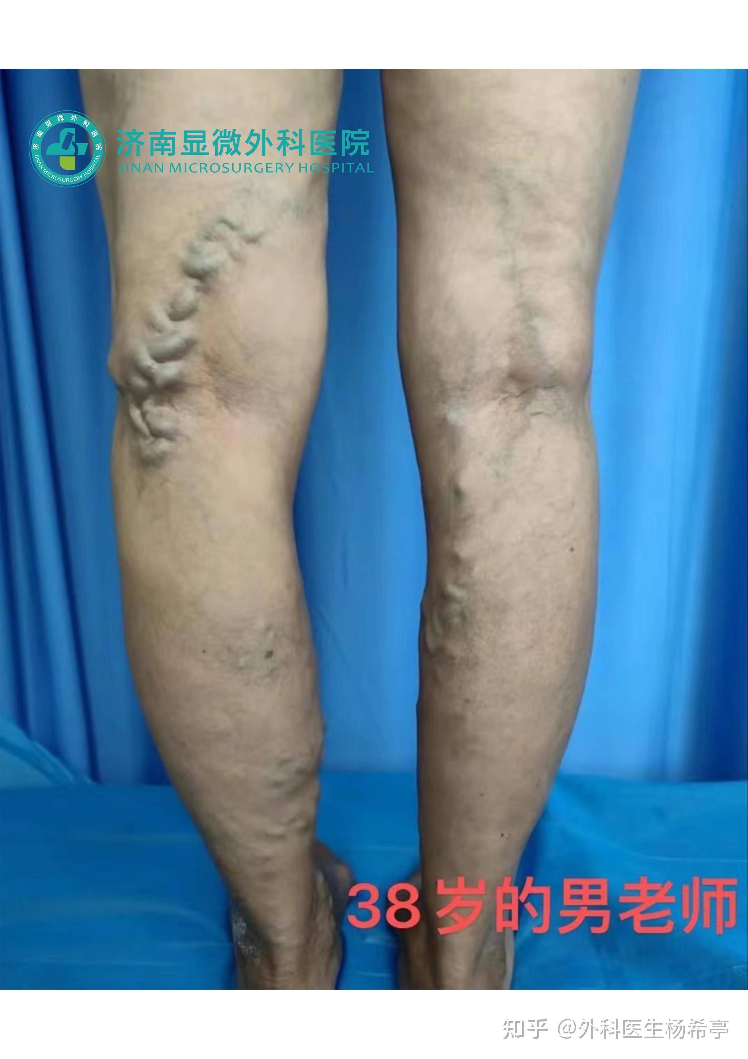 轻度静脉曲张怎么治疗 - 知乎