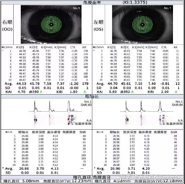 icl晶体植入术前和术后要做哪些检查一次说明白
