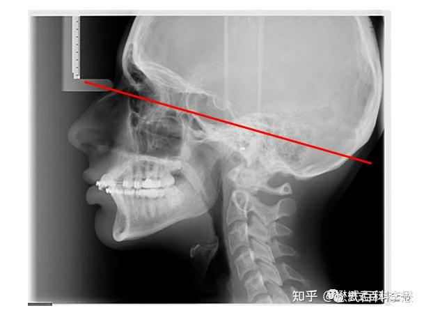 图8:听眦线ct扫描定位像上要找听眦线omb线实际上也不好找,早期的ct