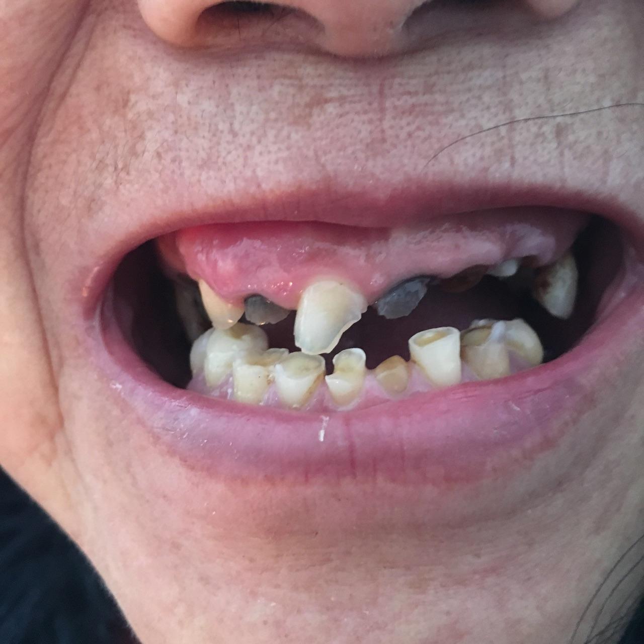 66岁牙齿都只剩下牙根,是应该全部拔了做种植