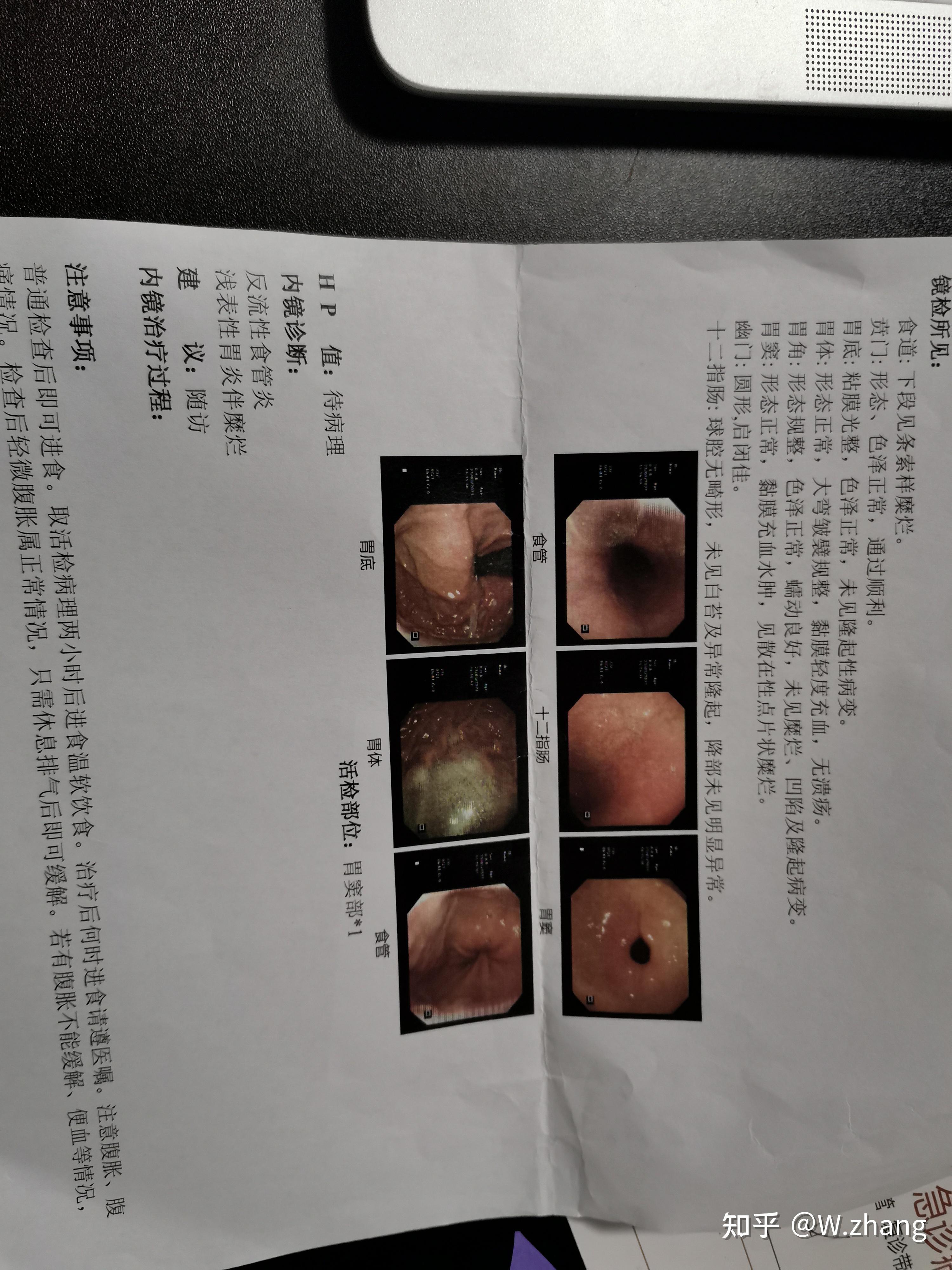 上海市周浦医院胃镜检查