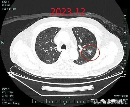 病例分享20231225這個肺癌病人有太多故事