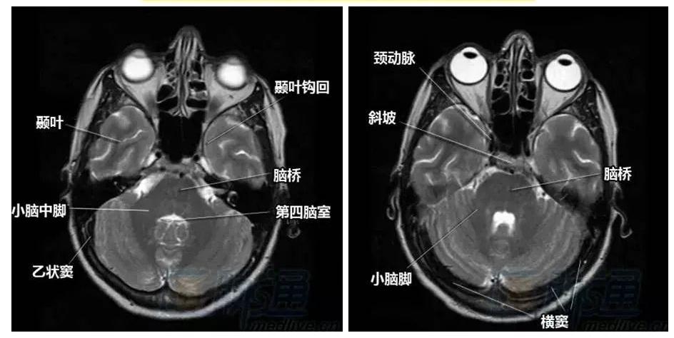 脑干-由中脑,脑桥,延髓构成血管周围间隙是软脑膜随着穿通动脉和流出