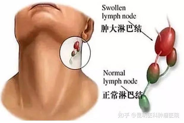 此外淋巴细胞白血病亦会导致淋巴结肿大