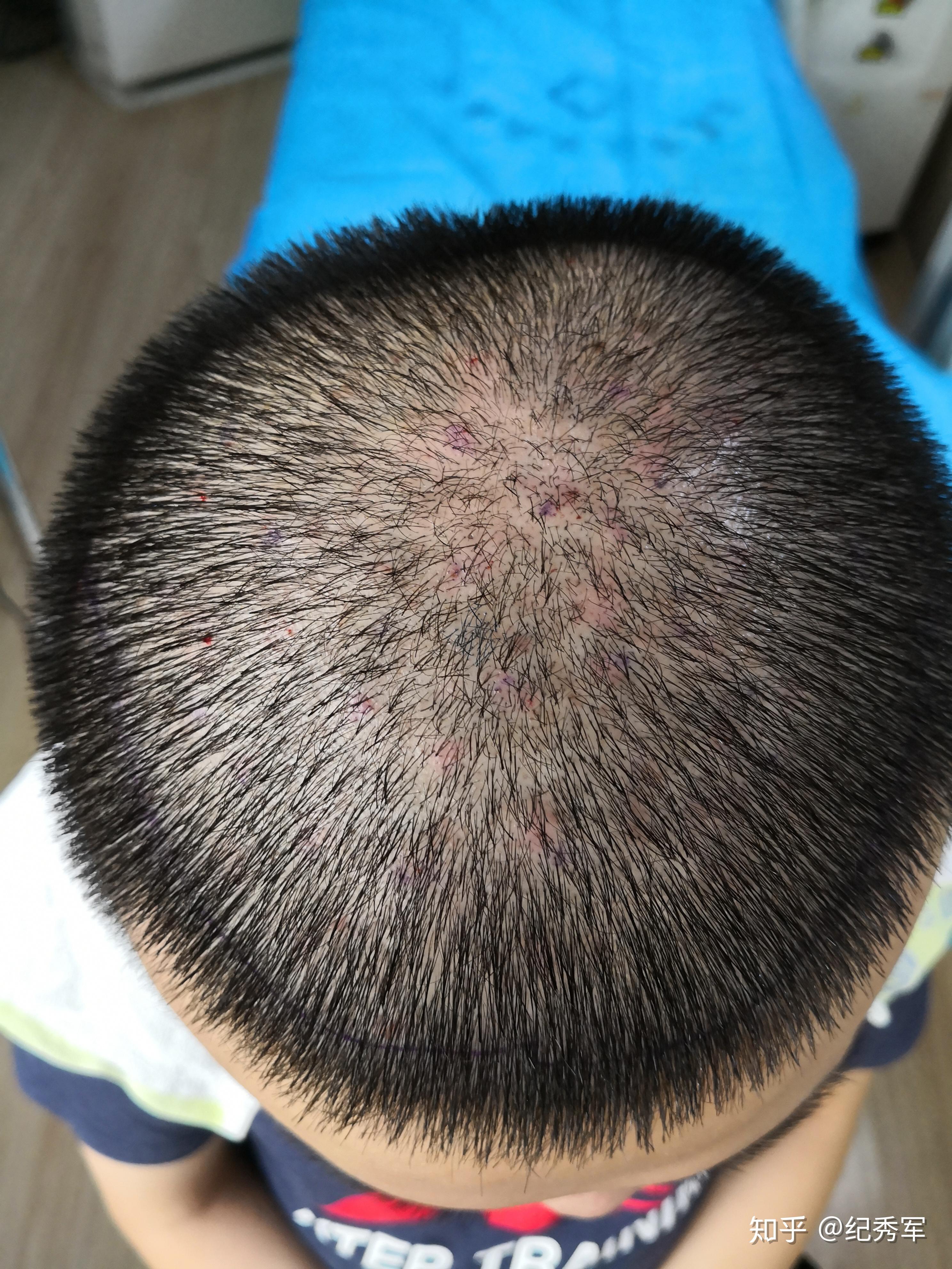 济南现代皮肤病医院：雄性激素脱发的治疗。_凤凰网视频_凤凰网