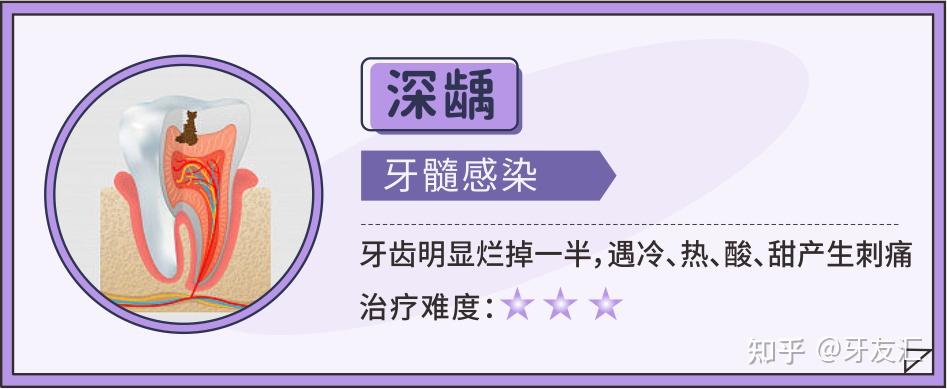 深龋不疼可以只补牙吗? - 知乎