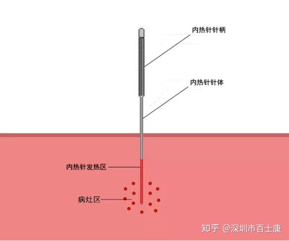 筋膜內熱針療法