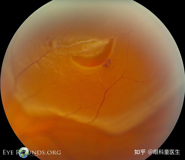 认识视网膜脱离 - 知乎