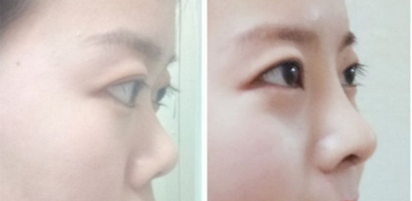 【审美+案例】朝天鼻改善-轻度和重度要分情况来看 - 知乎