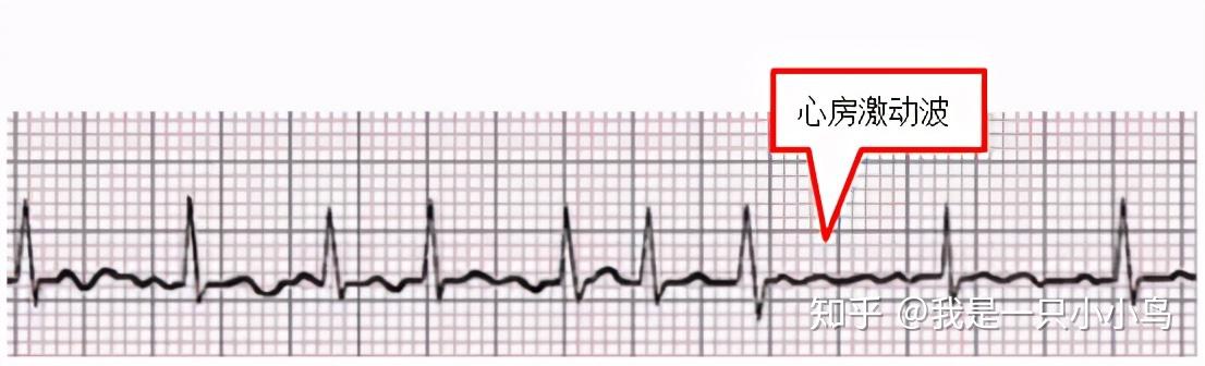 掌握常見心電圖我的心臟我做主