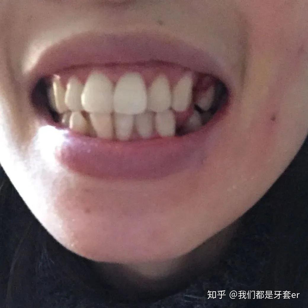 牙齿两颗大门牙上，是长了个东西吗，有点疼，怎么办_口腔科_邻医网