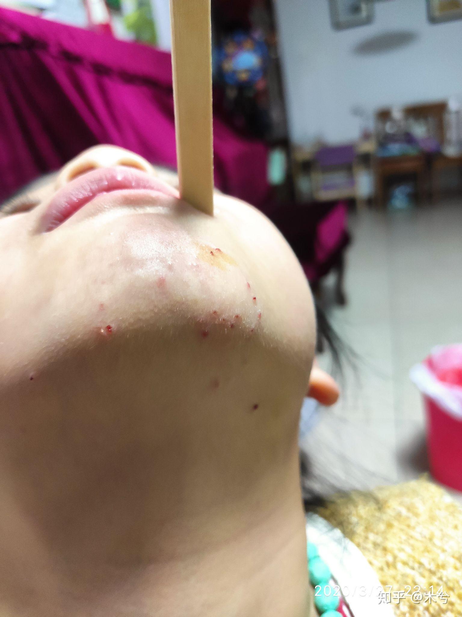 儿童下巴长传染性软疣,治疗全过程(图片涉及自家宝宝,请勿他用,谢谢)