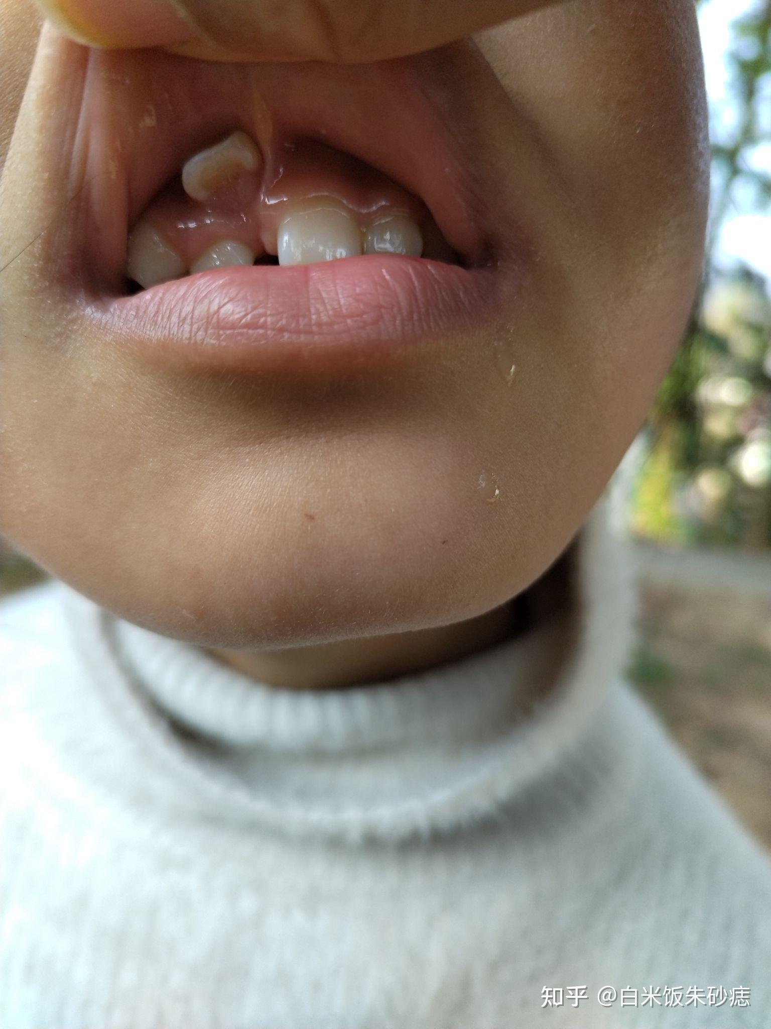 儿童上颌埋伏多生牙拔除（病例）-春雨医生
