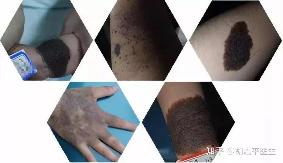 黑胎记的3大常见类型症状