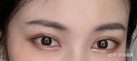 杭州全切双眼皮眼修复哪个医生做的好擅长平扇和平行双眼皮风格的医生