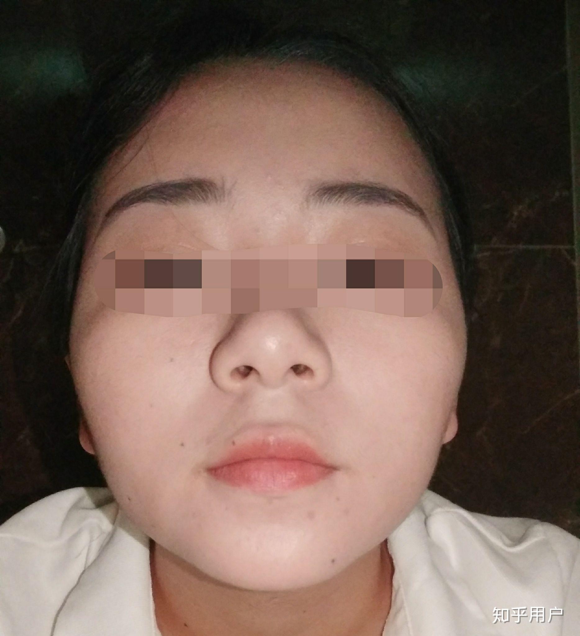 求解救有知友知道我这是颧骨的原因导致的脸宽吗