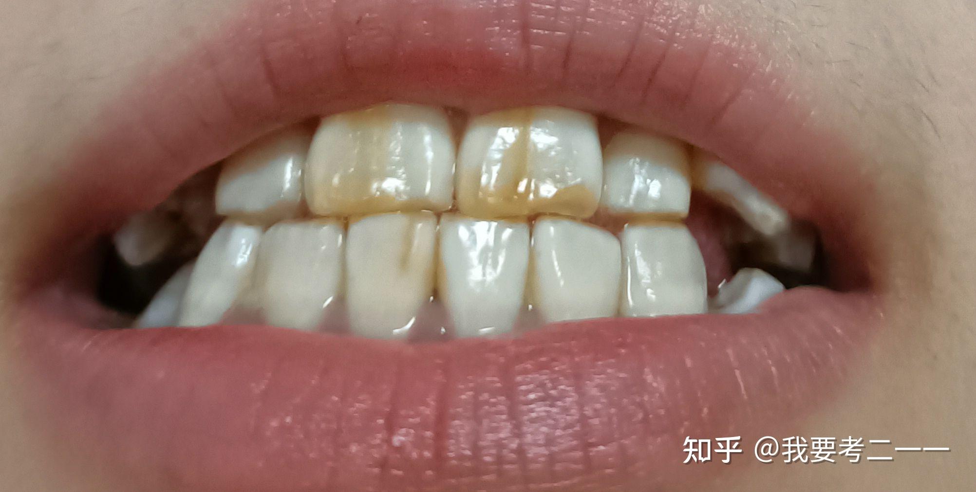 氟斑牙/氟化牙牙齿贴面美白历程个人故事分享 - 1 （持续更新） - 知乎