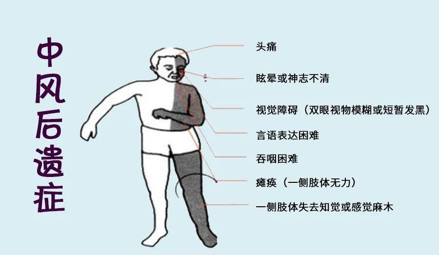 这其实是中风后遗症,是患者中风后肢体肌张力增高,肌肉痉挛引发关节