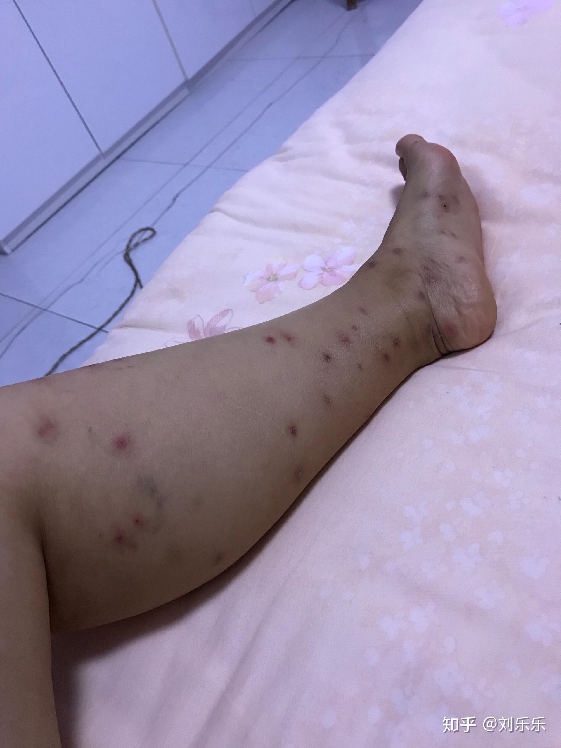 被跳蚤咬过的腿