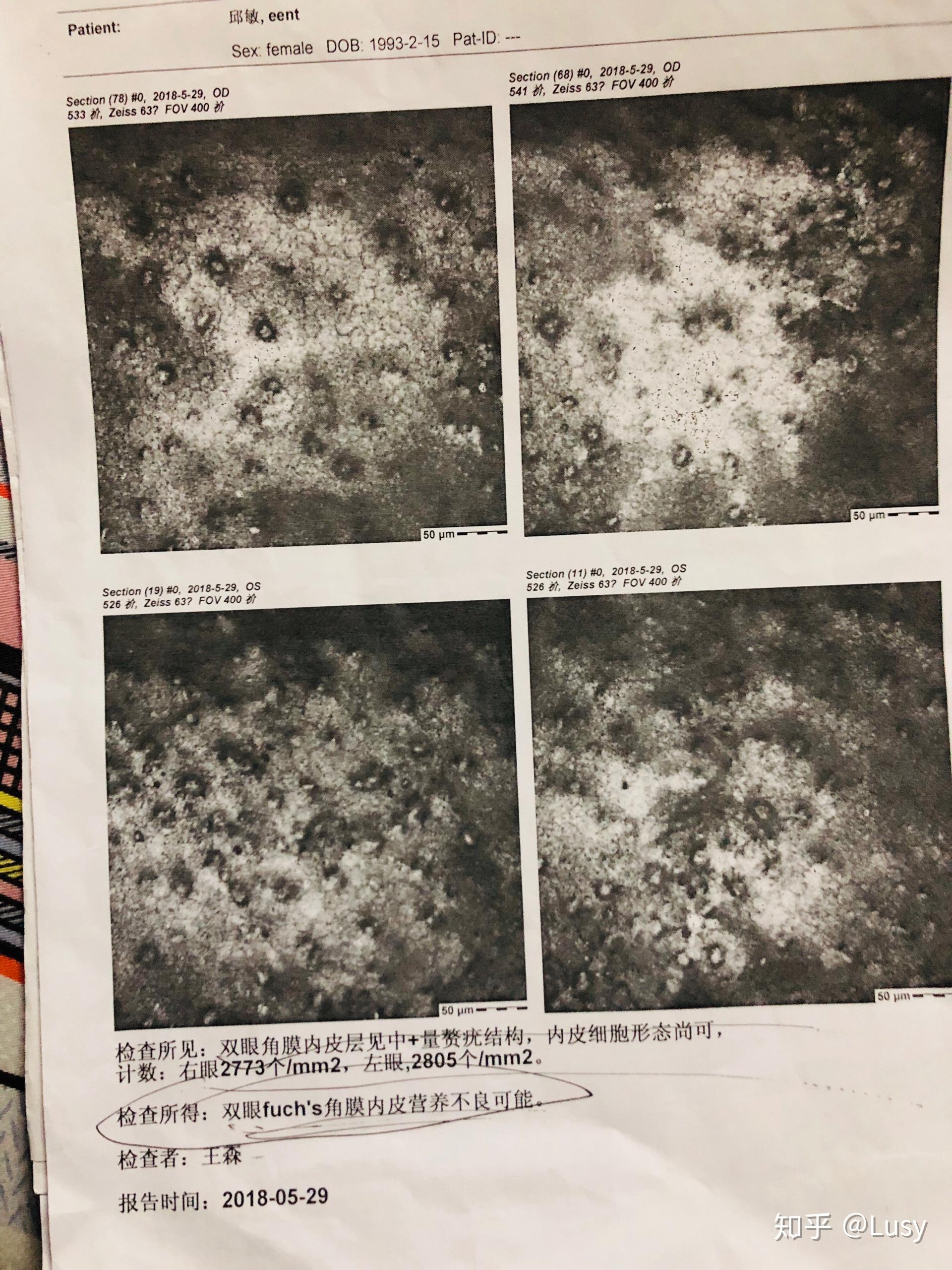 fuchs角膜内皮营养不良先天性白内障患者自述