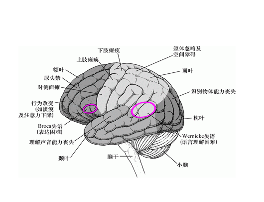 失语症6种类型图片图片