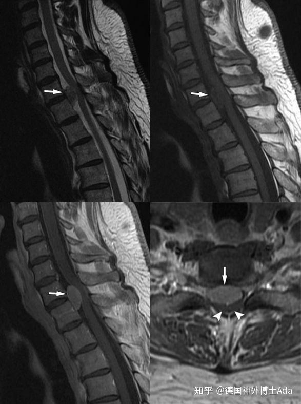 六大椎管内硬膜下肿瘤影像特点及手术策略解析