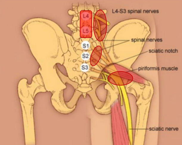 坐骨神经痛的拉伸康复