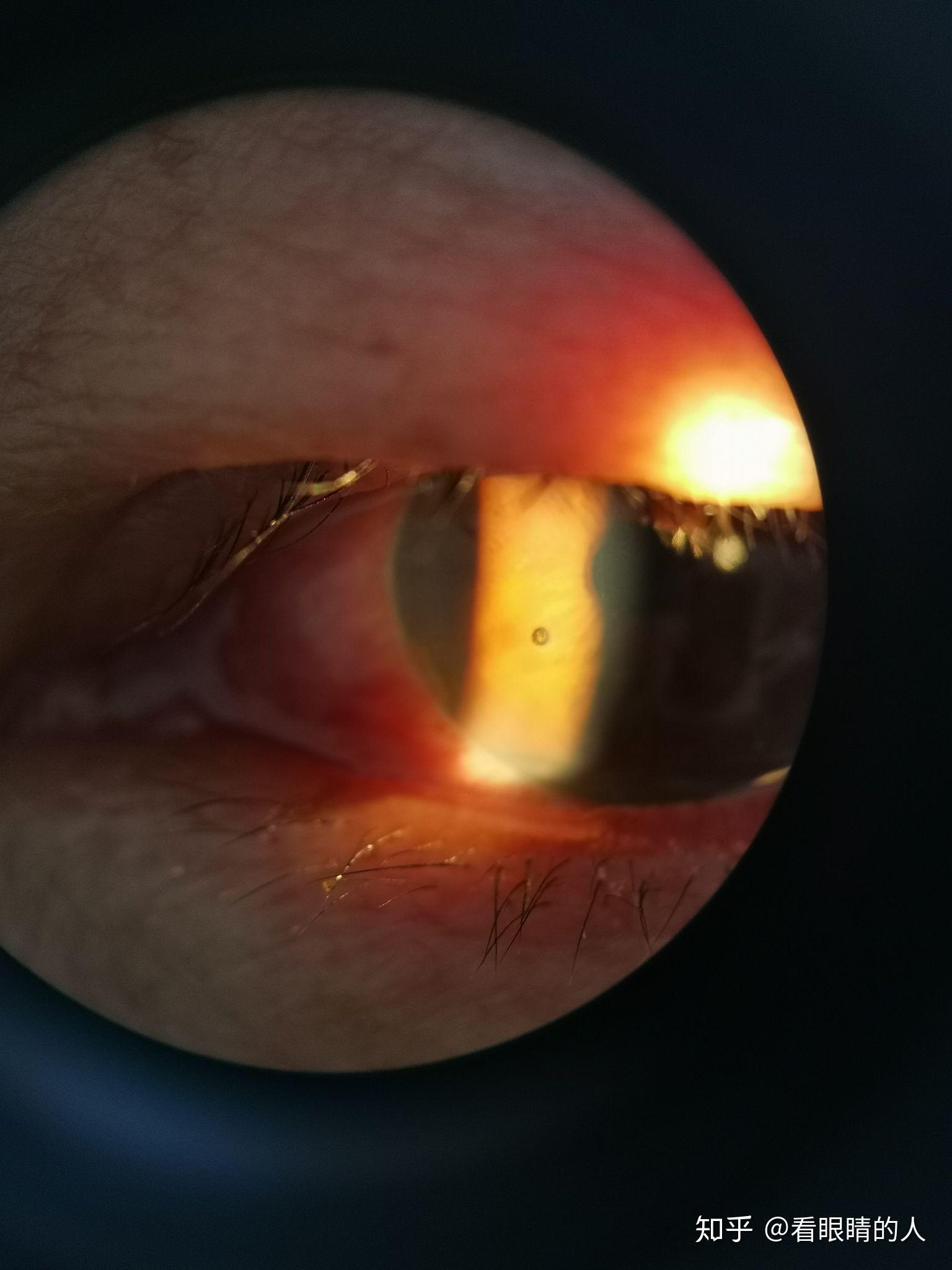 7.角膜异物,多见于电焊工人切割工人6.角膜上皮擦伤6.