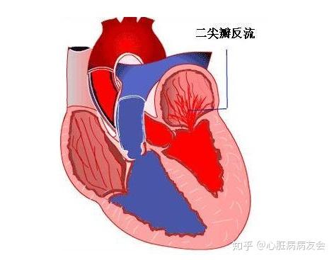 心脏二尖瓣轻微反流是怎么回事