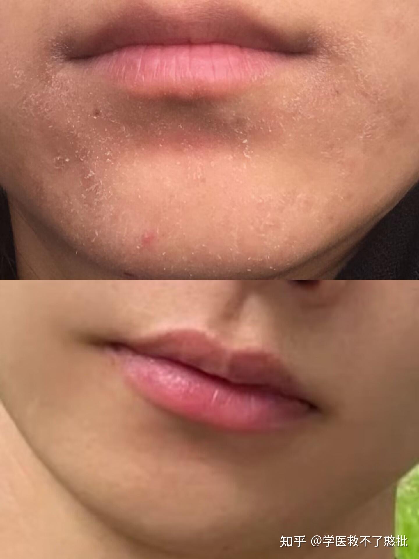 一到冬天就干燥起皮,下巴就成了重灾区无论尝试什么补水面膜都没用