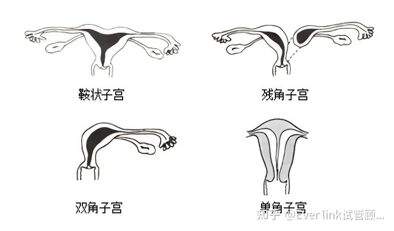 1,子宫构造异常:如:子宫先天发育畸形(双角子宫,子宫腔有纵膈),子宫