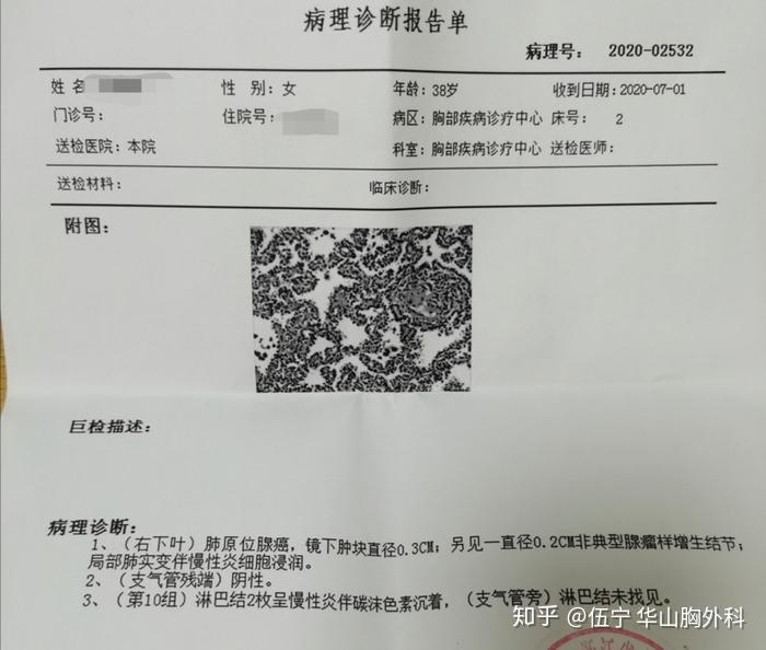 38岁门诊患者原位癌外院行肺叶切除这样的处理合适么