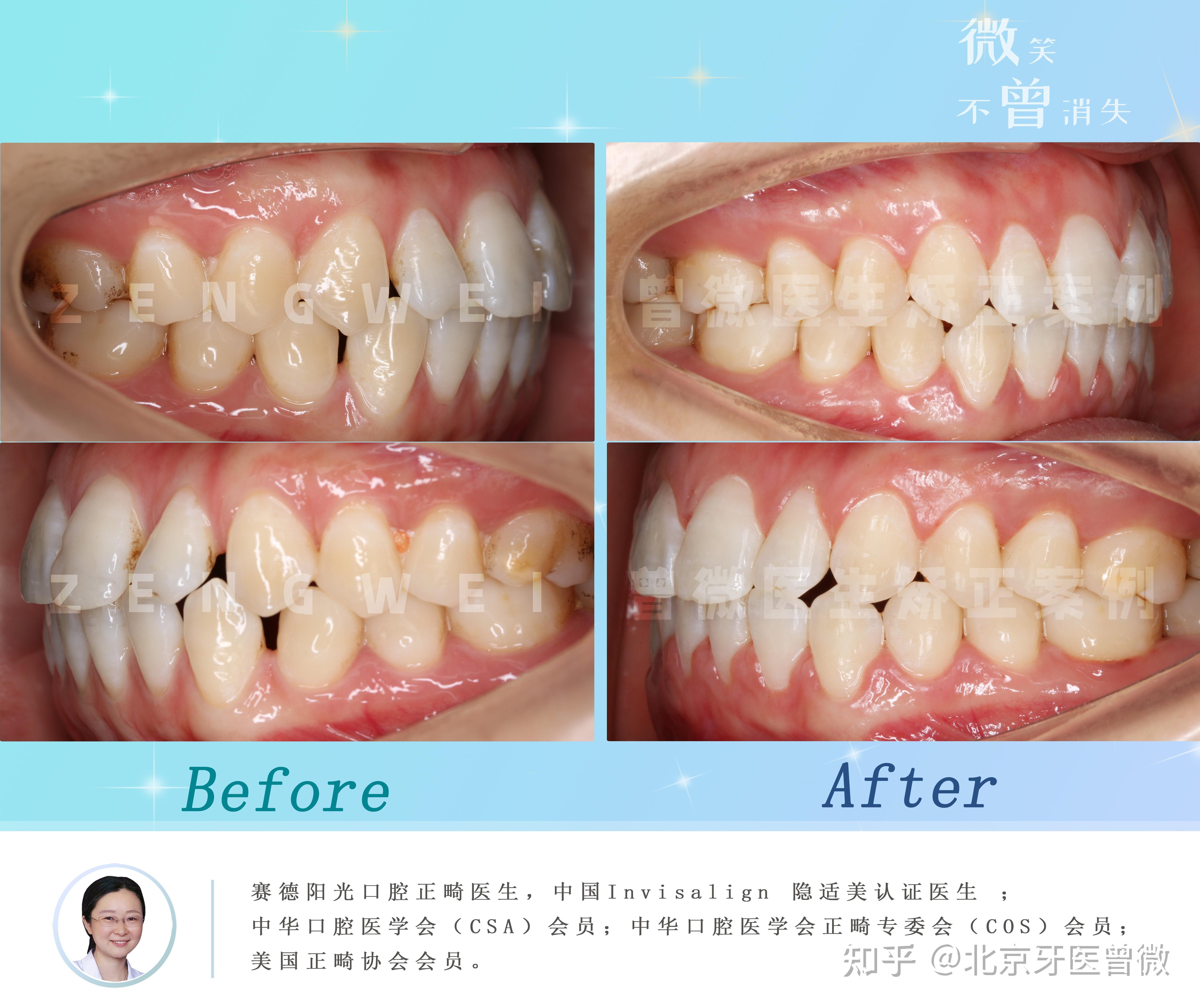 治疗情况:通过正畸回收前牙,调整咬合关系.