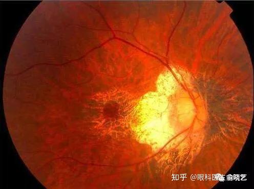 拍照范围可达到220°~240,能够覆盖眼底82%的视网膜,对瞳孔直径要求小