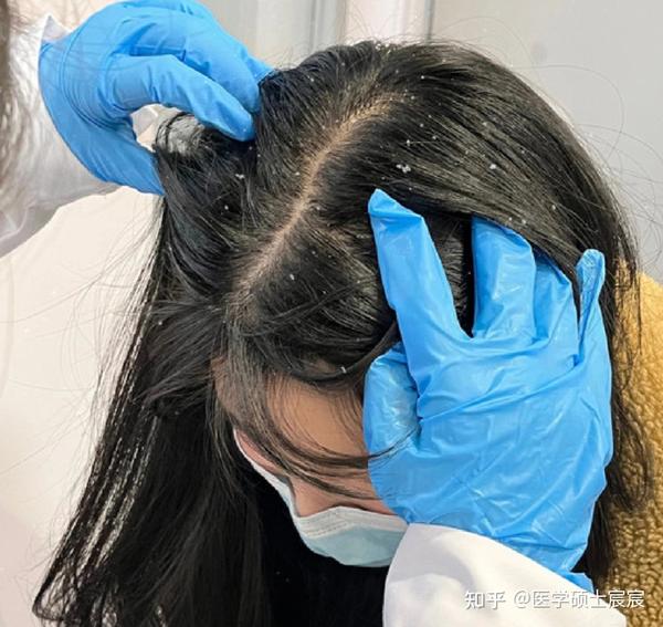 头皮油腻瘙痒、头皮屑疯涨、掉发多?别再怪洗发水了!医学硕士告诉你,这都是螨虫在作祟!学会正确除螨,头皮问题一步到位!! - 知乎