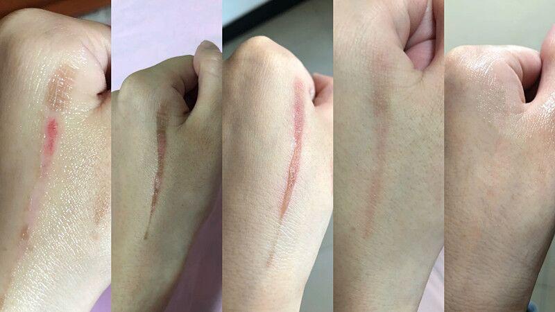 缝针疤剖腹产疤水痘疤我被疤痕体质折磨疯了谁能救救我