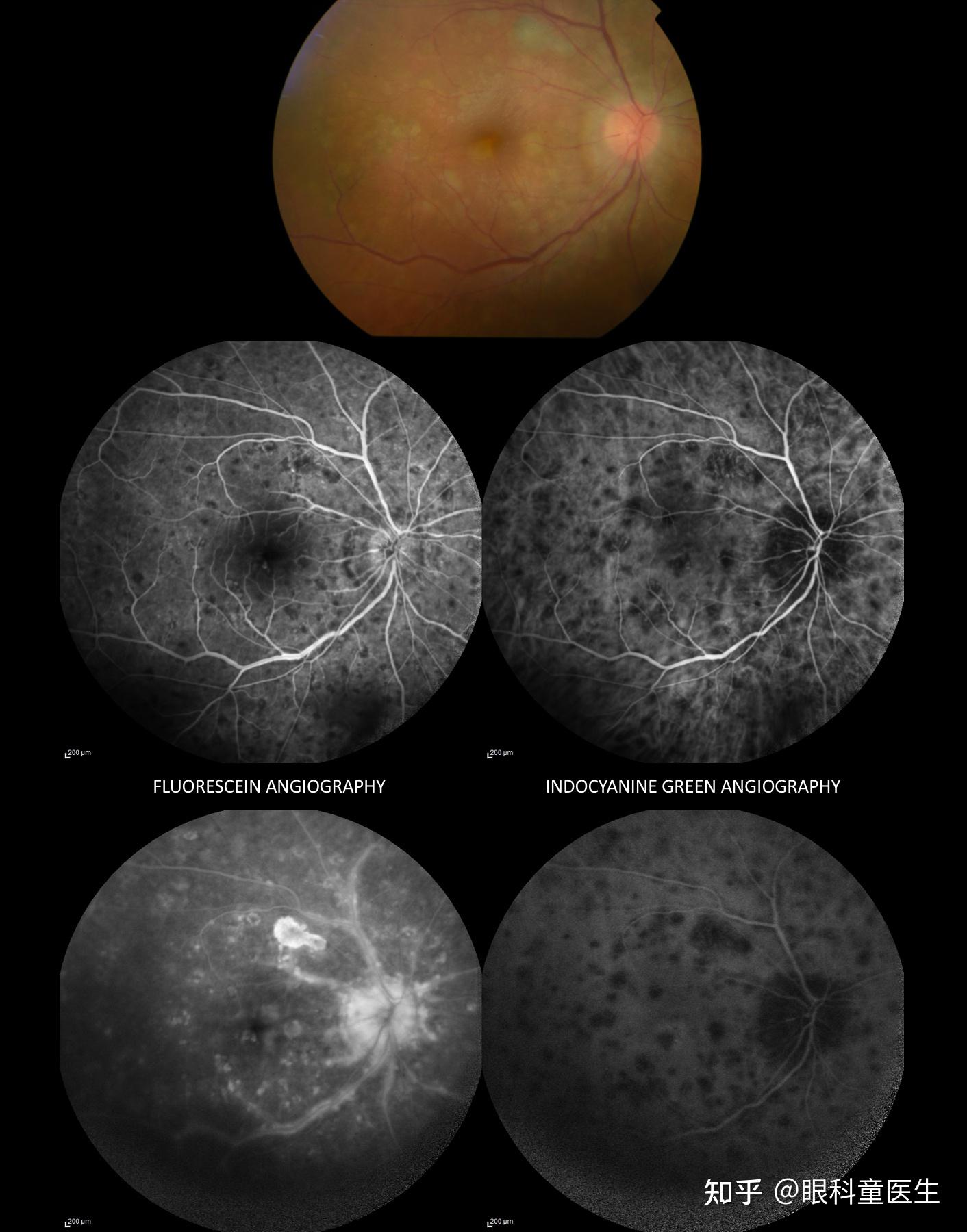 交感性眼炎(sympathetic ophthalmia)