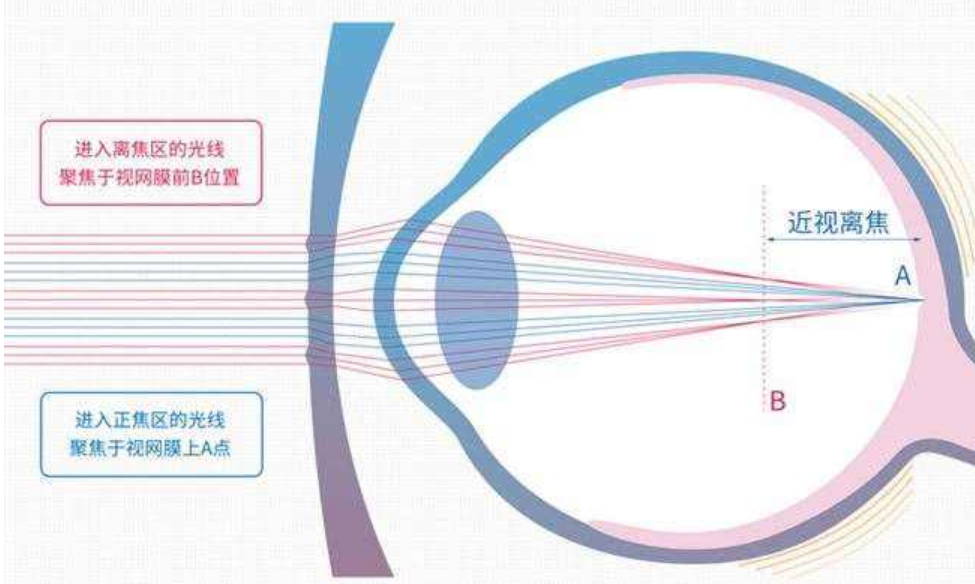 有哪些镜片表面有很多小点点微透镜离焦镜片总结