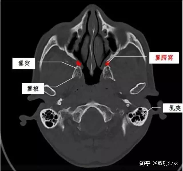 翼突钩增生图片