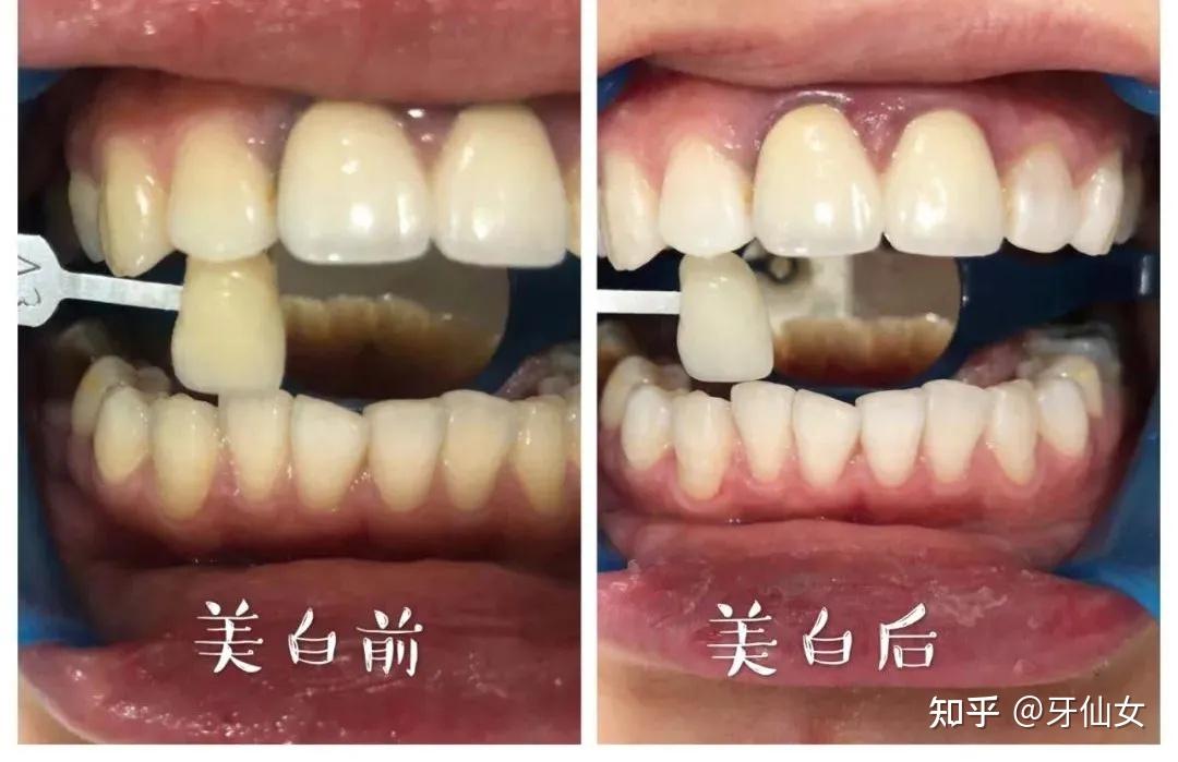 洗牙不能让牙齿变白但这几种方法可以